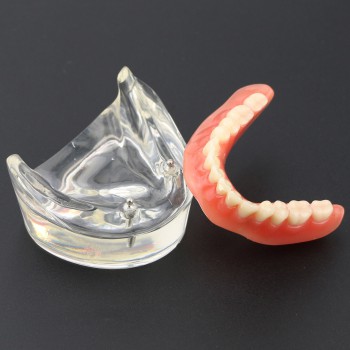 Dental Teeth Model Overdenture Inferior with 2 Implants Study Demo Model 6002 01