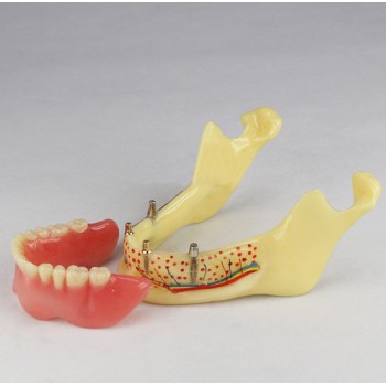 Dental Teeth Implant Model Jaw M-2014B