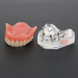 Dental Study Teeth Model Overdenture With 4 Implants Demo Model 6001