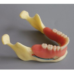 Dental Model #2014 02 - Mandible Implant and Overdenture Demo Model (Yellow)