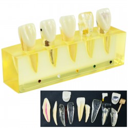 Dental Teeth Model 5Stages Demonstration Endodontic Treatment Root Canal Incisor