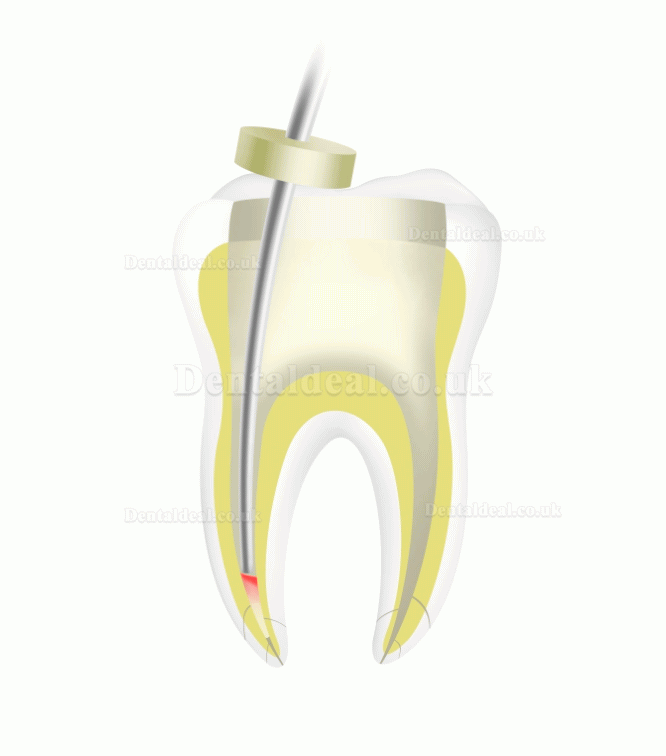 Woodpecker Fi-P Dental Cordless Gutta-percha Endo Obturation Pen