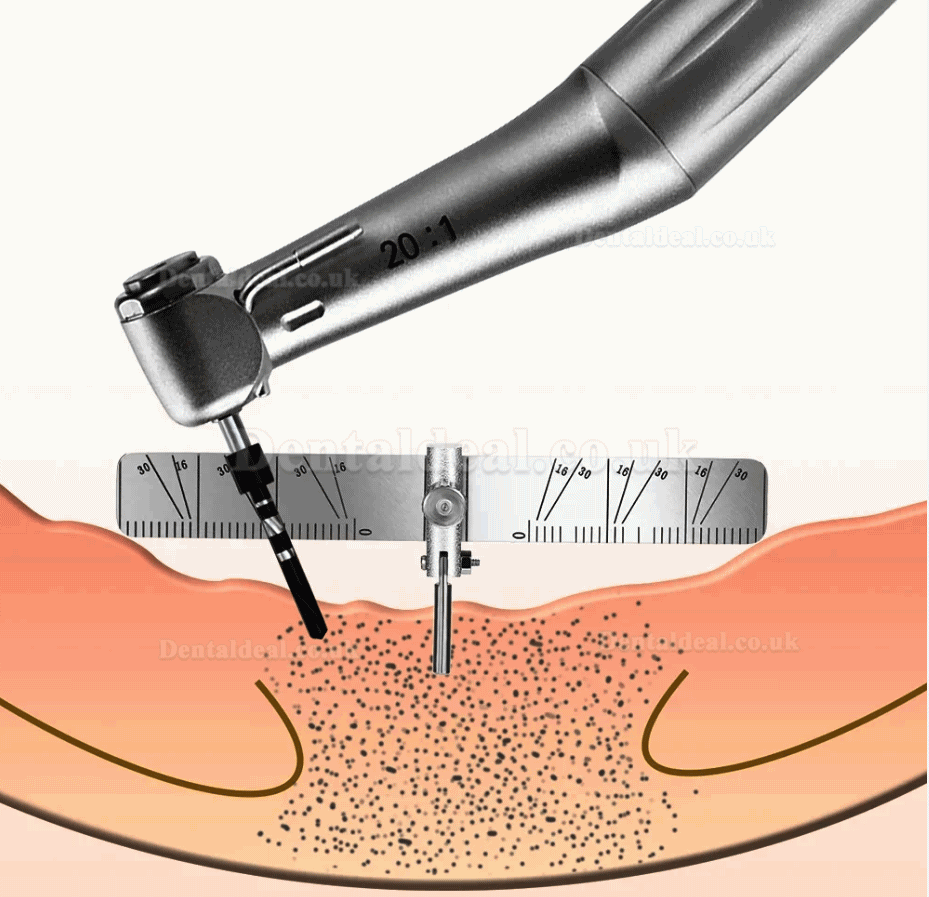 Dental Implant Locating Guide Surgical Planting Positioning Locator Ruler Gauge