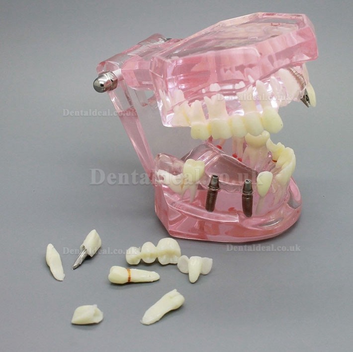 Dental Implant Study Analysis Demonstration Teeth Model with Restoration PINK