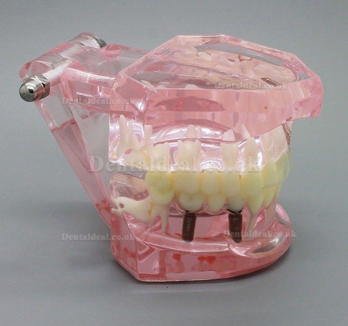 Dental Implant Study Analysis Demonstration Teeth Model with Restoration PINK