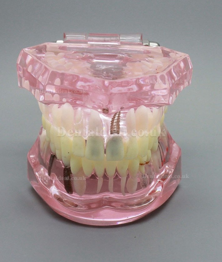 Dental Implant Study Analysis Demonstration Teeth Model with Restoration PINK