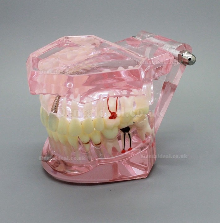 Dental Implant Study Analysis Demonstration Teeth Model with Restoration PINK