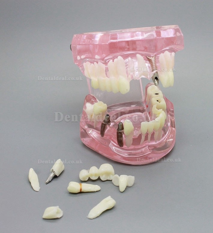 Dental Implant Study Analysis Demonstration Teeth Model with Restoration PINK