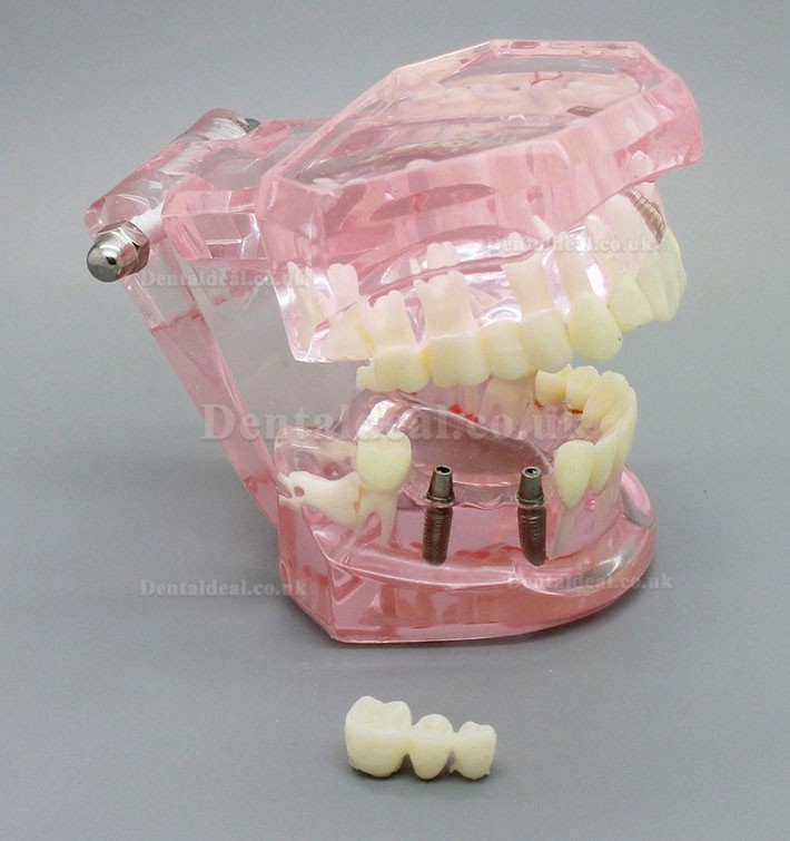 Dental Implant Study Analysis Demonstration Teeth Model with Restoration PINK