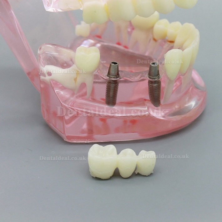 Dental Implant Study Analysis Demonstration Teeth Model with Restoration PINK