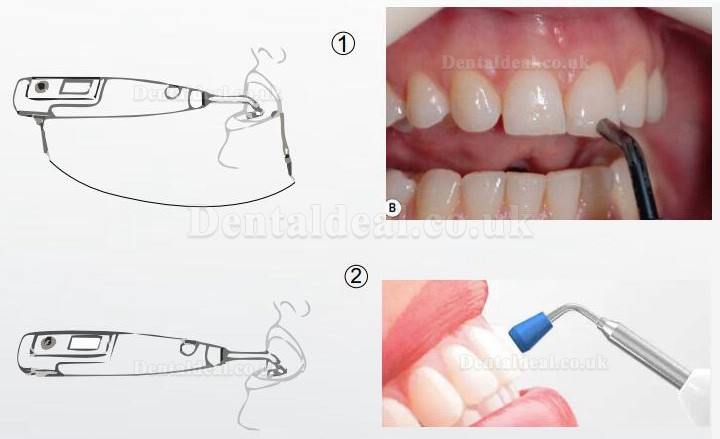 Denjoy MeteEndo Moible Dental Endo Integrated Cart System (with Meta Fill/Meta Pex/Meta Motor/Meta Pulp/Meta Pack)