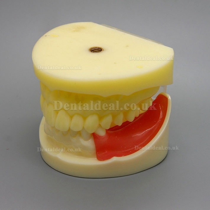 Dental Implant Surgery Practice Model With Replaceable Gingiva 2002