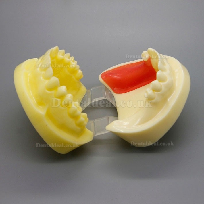 Dental Implant Surgery Practice Model With Replaceable Gingiva 2002