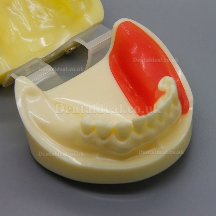 Dental Implant Surgery Practice Model With Replaceable Gingiva 2002