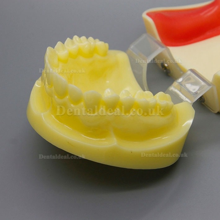 Dental Implant Surgery Practice Model With Replaceable Gingiva 2002