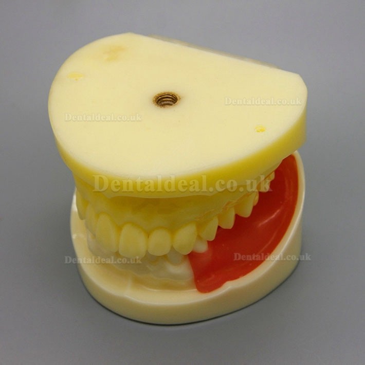 Dental Implant Surgery Practice Model With Replaceable Gingiva 2002