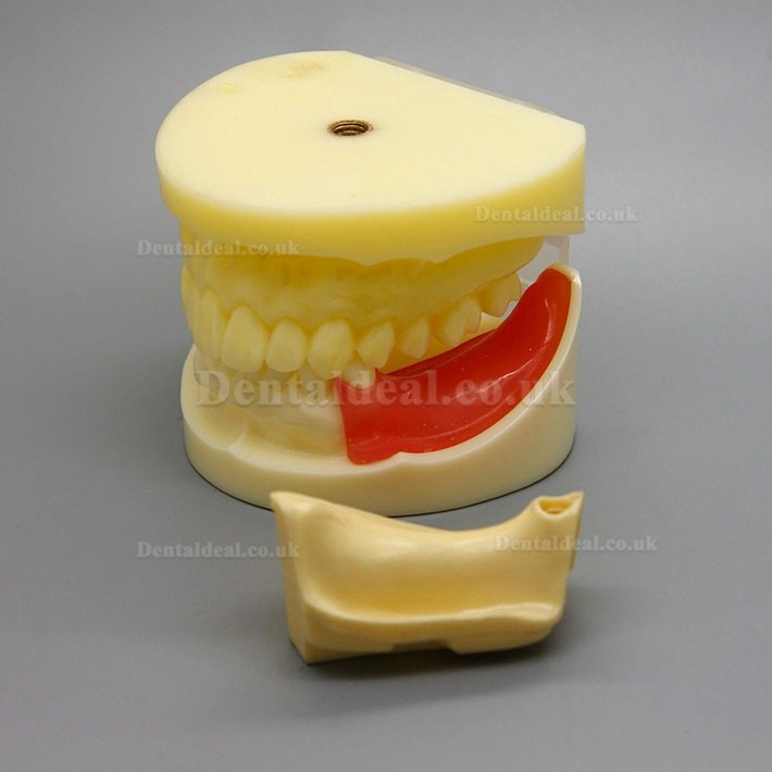 Dental Implant Surgery Practice Model With Replaceable Gingiva 2002