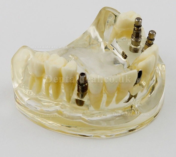 Dental Upper Jaw Implant Surgery Study Dem Model 2005