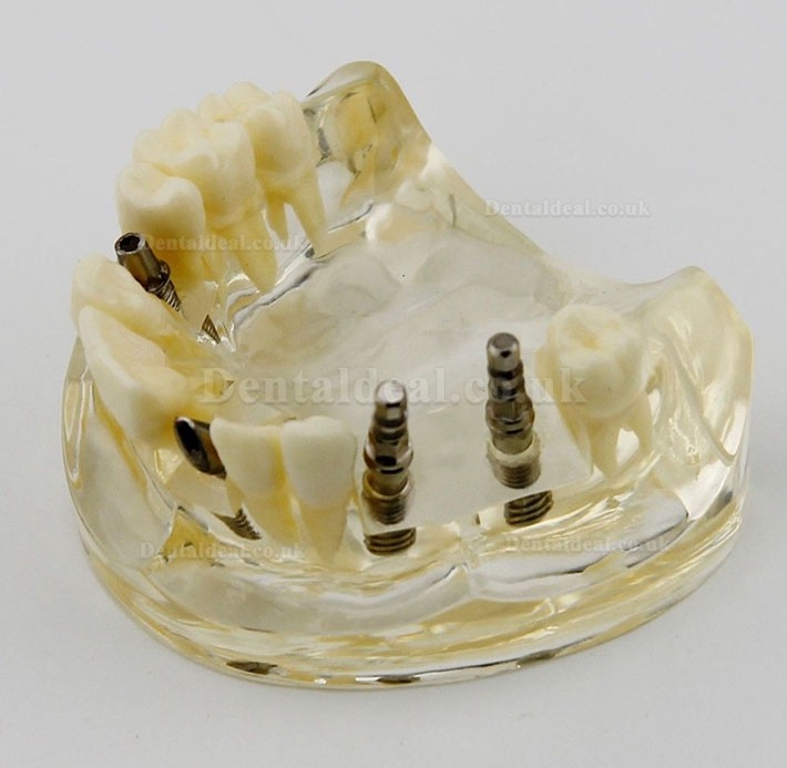 Dental Upper Jaw Implant Surgery Study Dem Model 2005