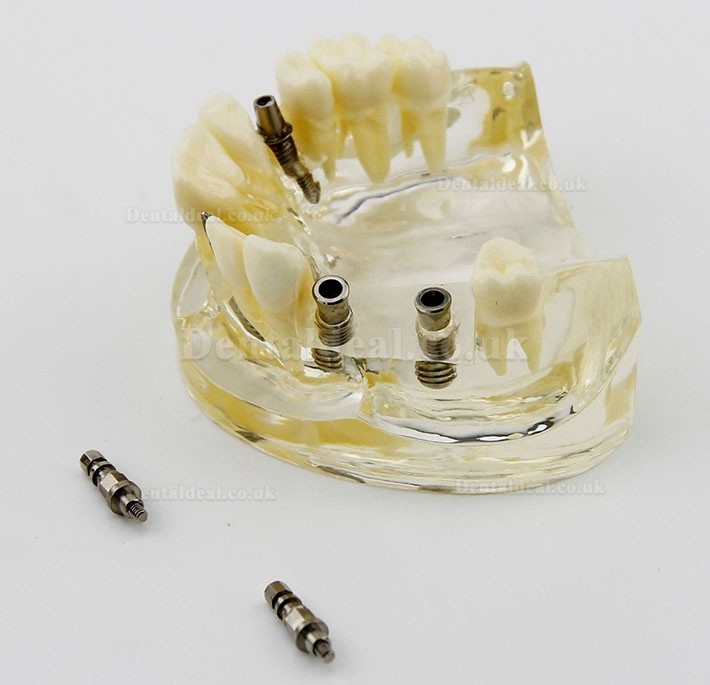 Dental Upper Jaw Implant Surgery Study Dem Model 2005