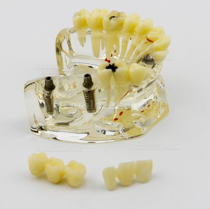 Dental Upper Jaw Implant Model with Bridge and Caries -I 2006