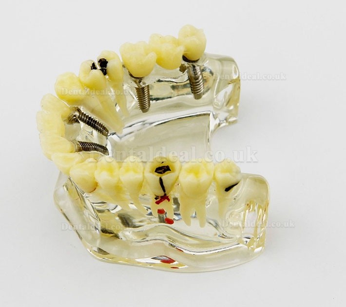 Dental Upper Jaw Implant Model with Bridge and Caries -I 2006