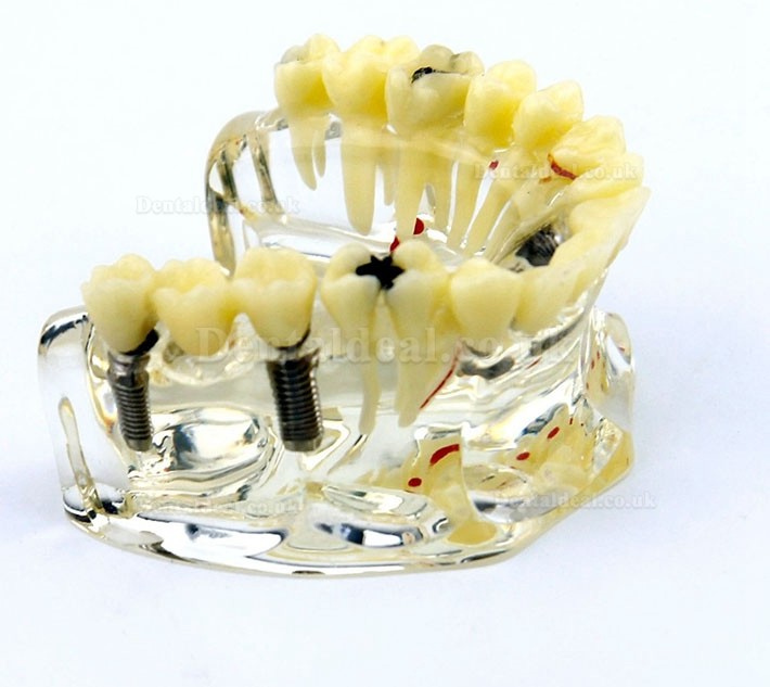 Dental Upper Jaw Implant Model with Bridge and Caries -I 2006