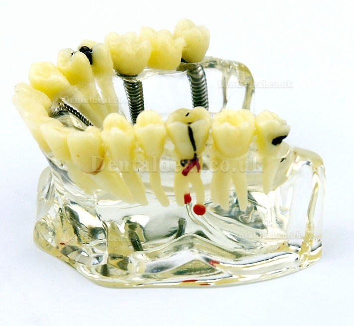 Dental Upper Jaw Implant Model with Bridge and Caries -I 2006