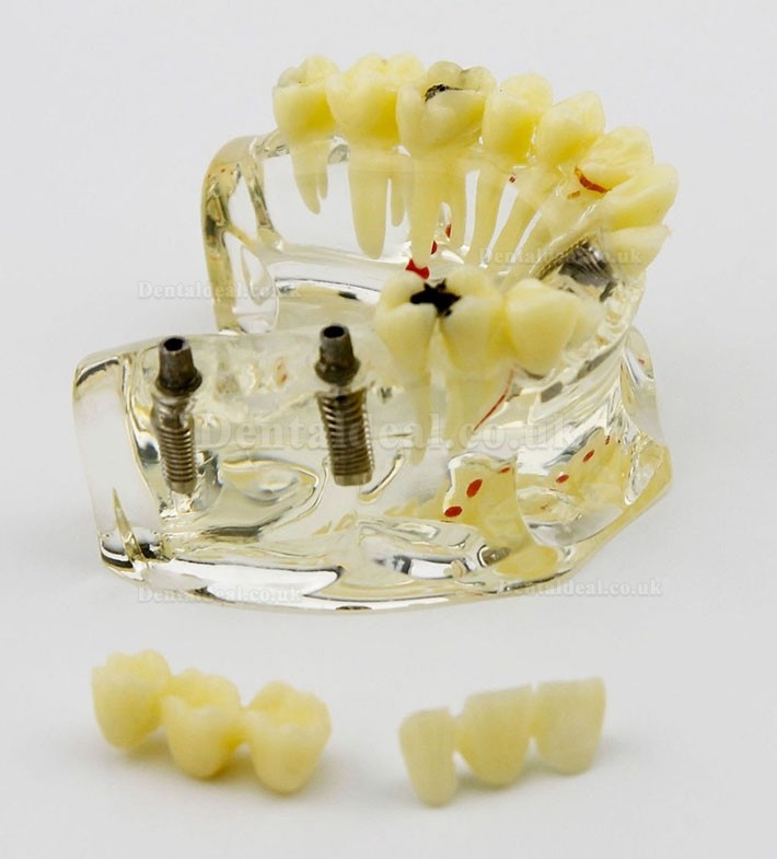 Dental Upper Jaw Implant Model with Bridge and Caries -I 2006