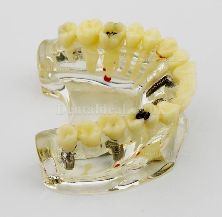 Dental Upper Jaw Implant Model with Bridge and Caries -I 2006