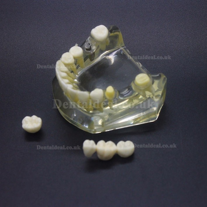 Dental Implant Study Typodont Model Lower Jaw Crown Bridge 2010