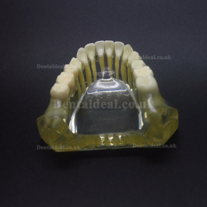 Dental Implant Study Typodont Model Lower Jaw Crown Bridge 2010