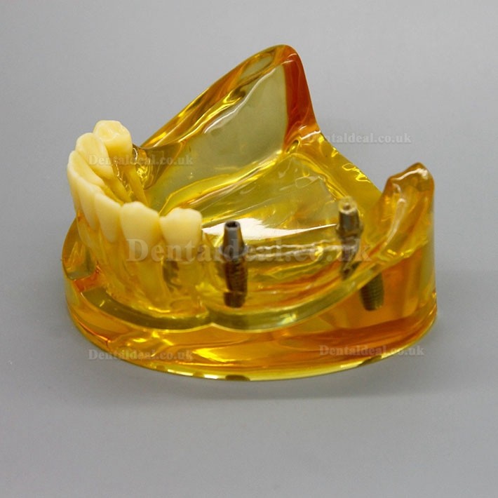 Dental Lower Jaw Implant Model With 2 Implants Bridges 2011