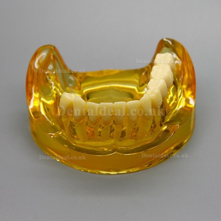 Dental Lower Jaw Implant Model With 2 Implants Bridges 2011