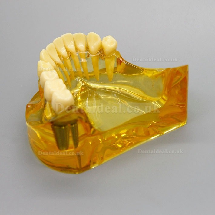 Dental Lower Jaw Implant Model With 2 Implants Bridges 2011