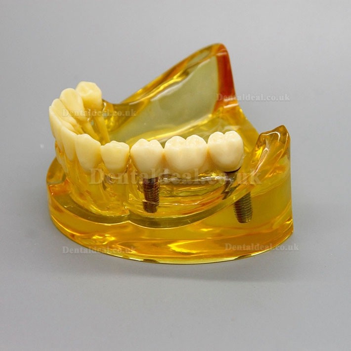 Dental Lower Jaw Implant Model With 2 Implants Bridges 2011