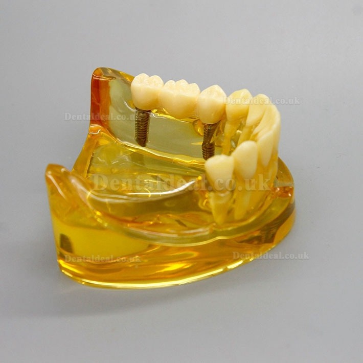 Dental Lower Jaw Implant Model With 2 Implants Bridges 2011