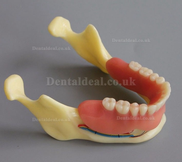 Dental Model #2014 02 - Mandible Implant and Overdenture Demo Model (Yellow)