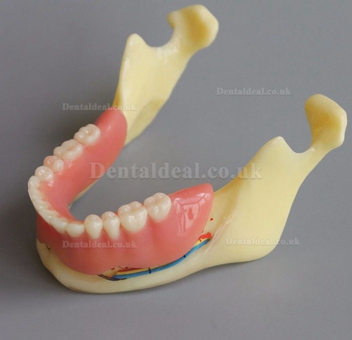 Dental Model #2014 02 - Mandible Implant and Overdenture Demo Model (Yellow)