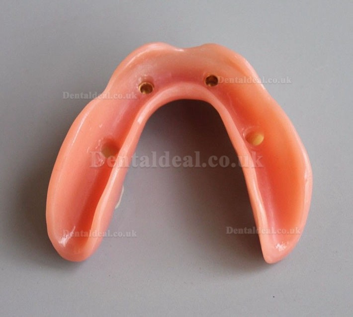 Dental Model #2014 02 - Mandible Implant and Overdenture Demo Model (Yellow)