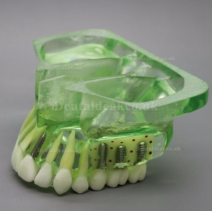 Dental Model 2015 01 Upper Jaw Implant Model with Sinus