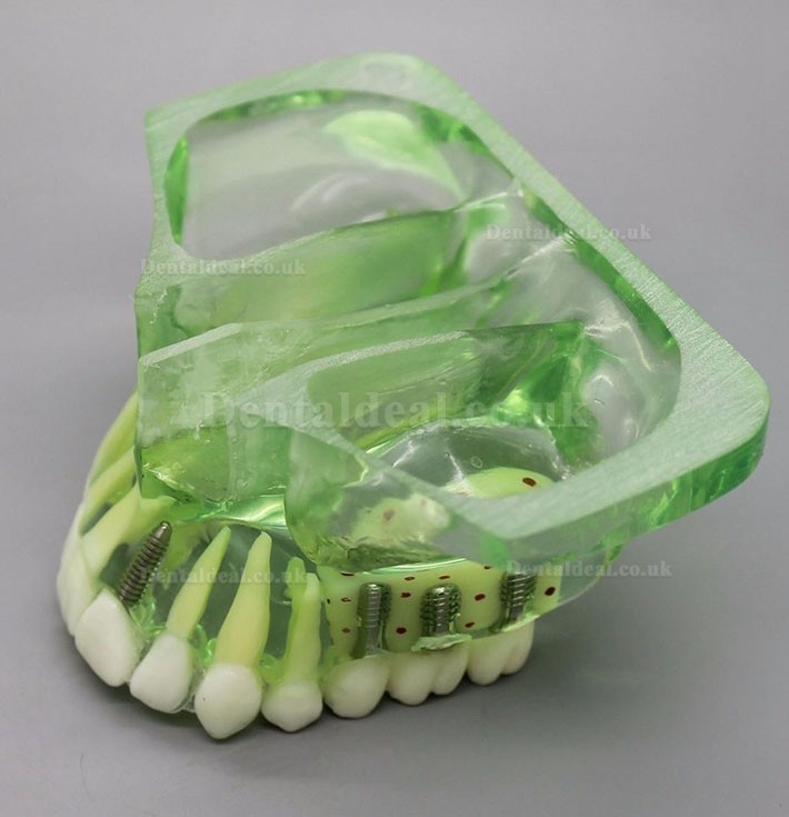 Dental Model 2015 01 Upper Jaw Implant Model with Sinus