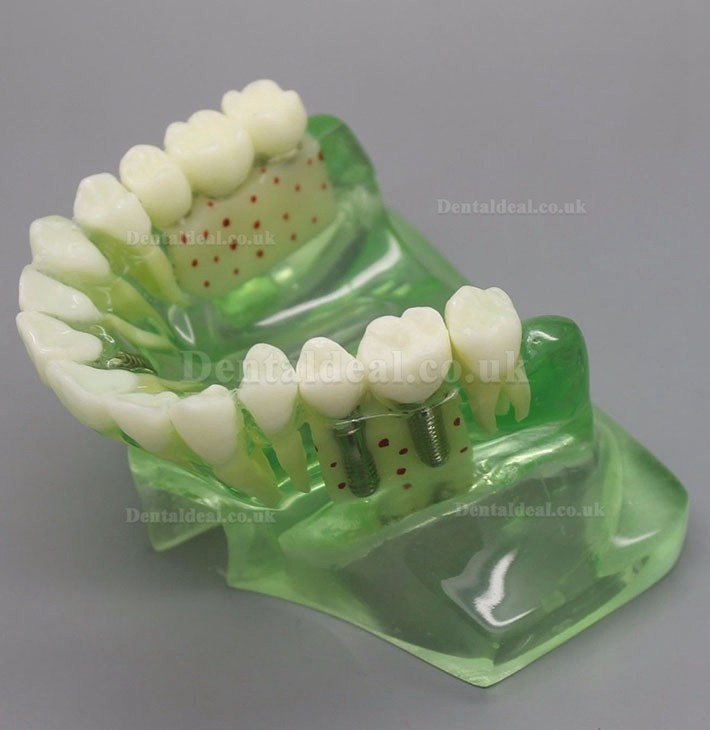 Dental Model 2015 01 Upper Jaw Implant Model with Sinus