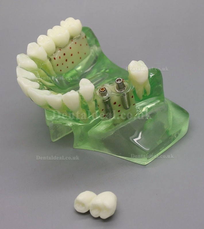 Dental Model 2015 01 Upper Jaw Implant Model with Sinus