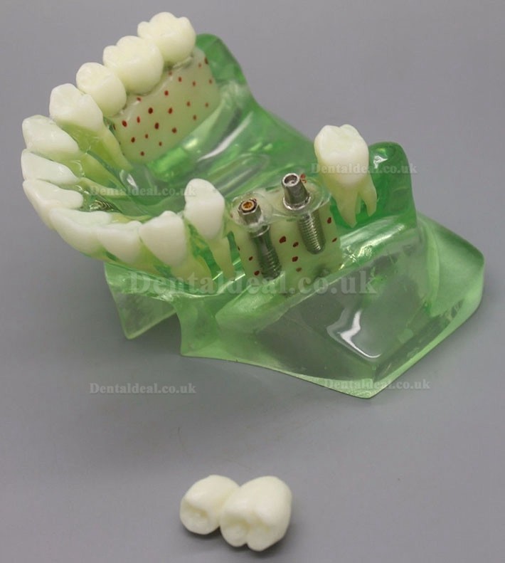 Dental Model 2015 01 Upper Jaw Implant Model with Sinus