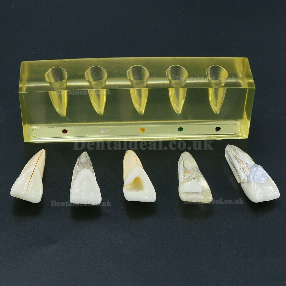 Dental Teeth Model 5 Stages Demonstration Endodontic Treatment Root Canal Incisor