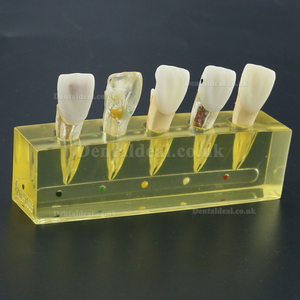 Dental Teeth Model 5 Stages Demonstration Endodontic Treatment Root Canal Incisor