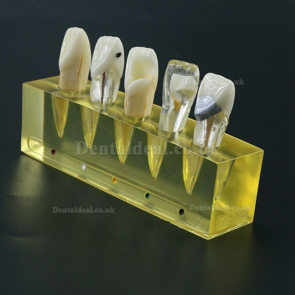 Dental Teeth Model 5 Stages Demonstration Endodontic Treatment Root Canal Incisor