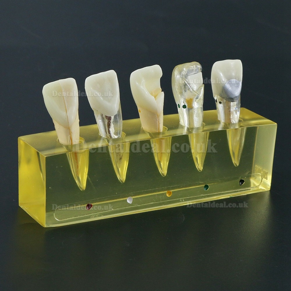 Dental Teeth Model 5 Stages Demonstration Endodontic Treatment Root Canal Incisor