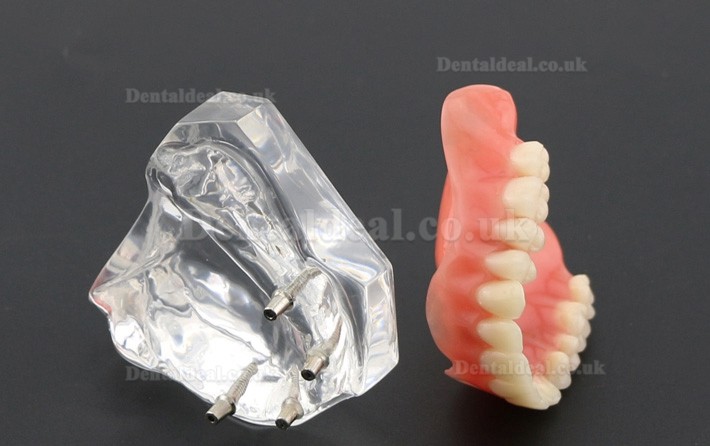 Dental Study Teeth Model Overdenture Superior With 4 Implants Demo Model 6001